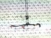 ecg